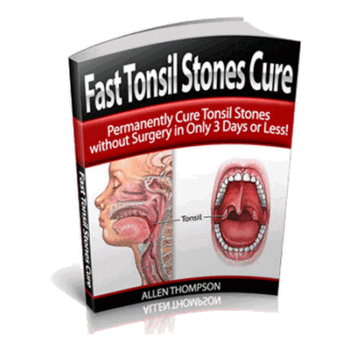 How to Cure Tonsil Stones